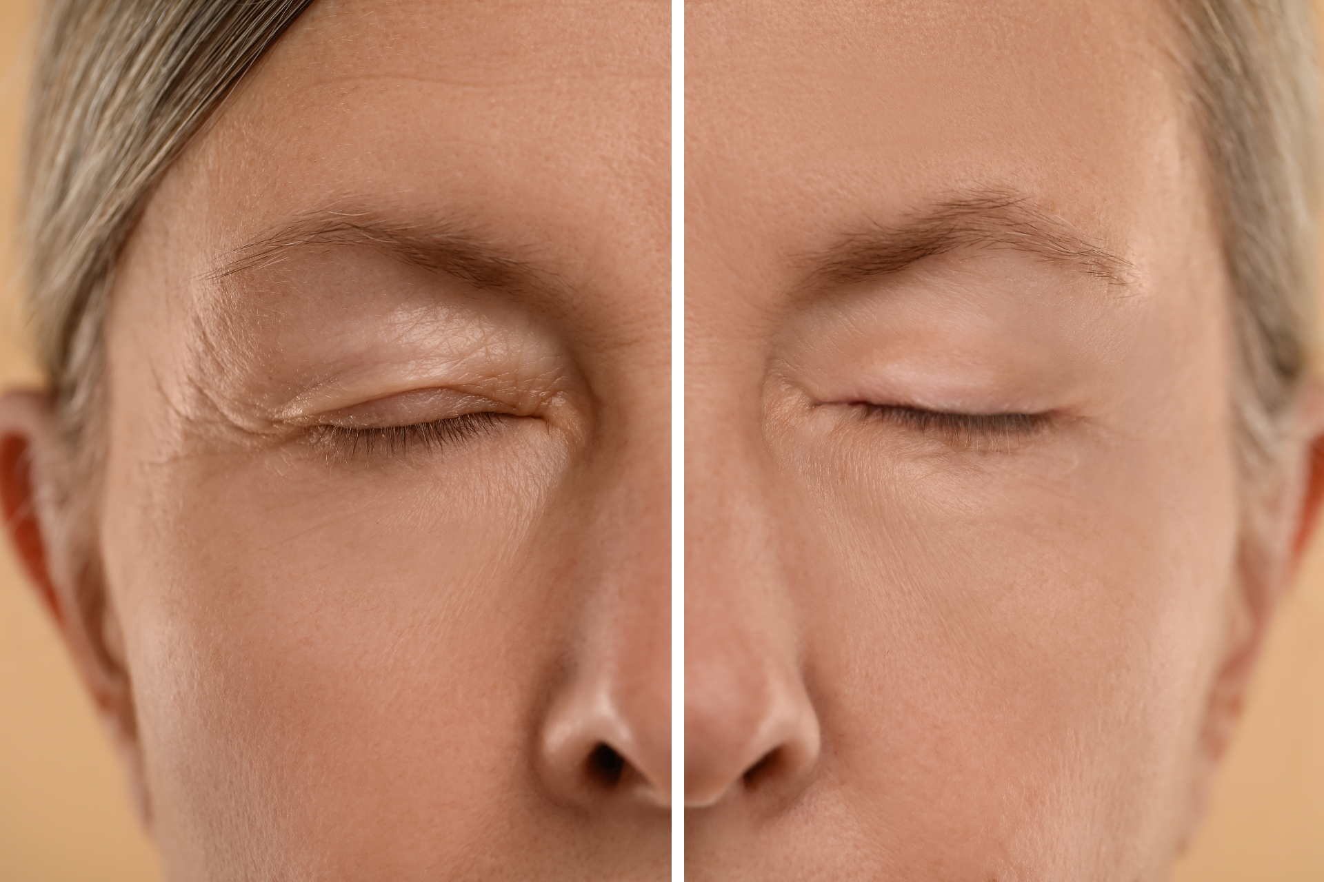 Blefaroplastia: qué es, candidatos y recuperación