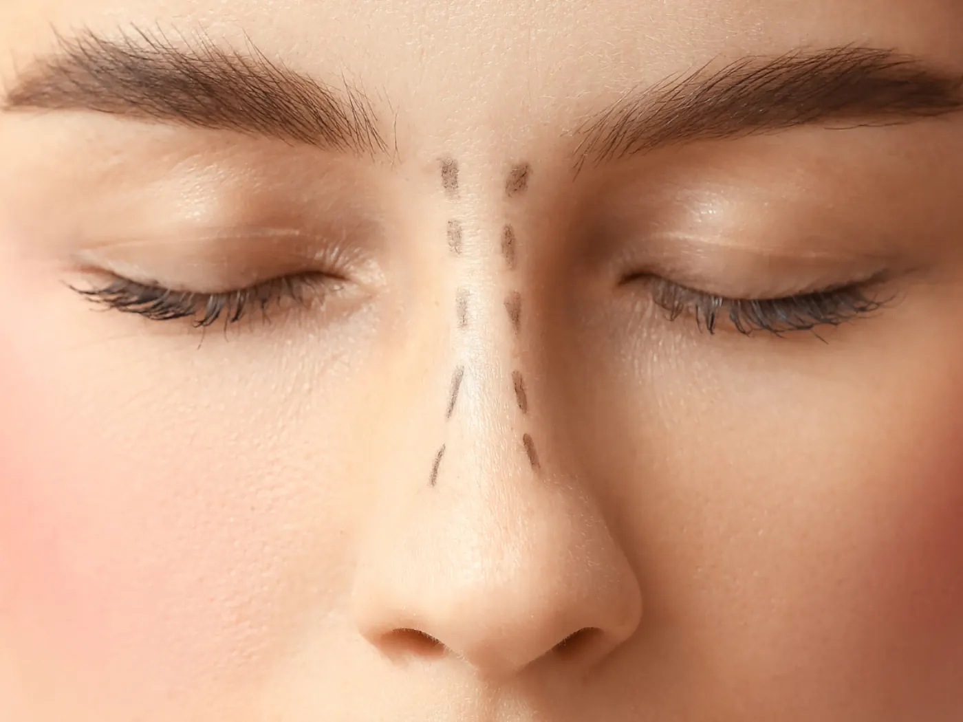 Cómo elegir un cirujano de rinoplastia en Costa Rica
