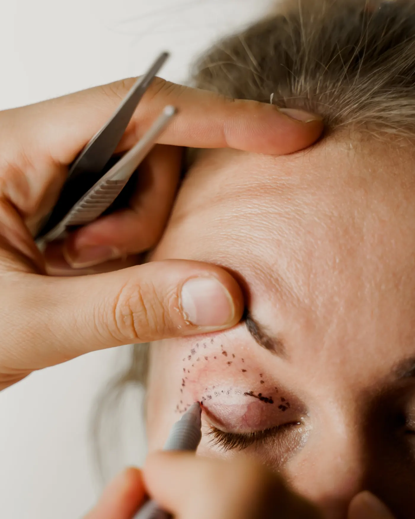Blefaroplastia — Dr. Camilo Comba, Costa Rica