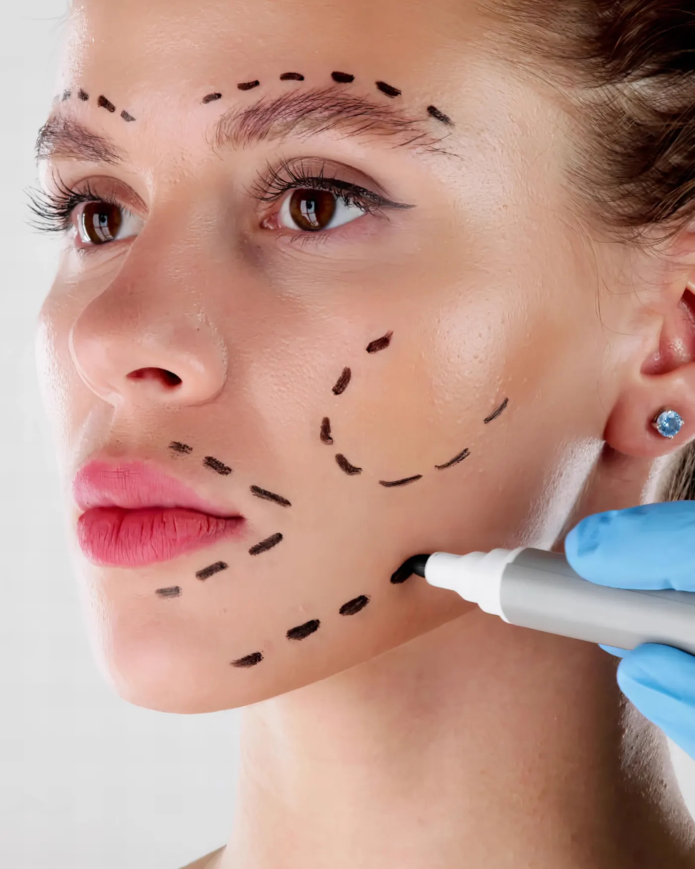 Lifting Facial — Dr. Camilo Comba, Costa Rica